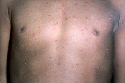 Stage 2 chickenpox on medium brown skin with pink and white blisters. A long description is available next.