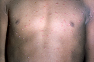About 80 pink chickenpox spots and blisters on the chest and arms. Some blisters are shiny. Shown on light brown skin.