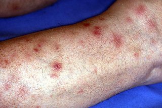 Erythema nodosum bumps and red patches