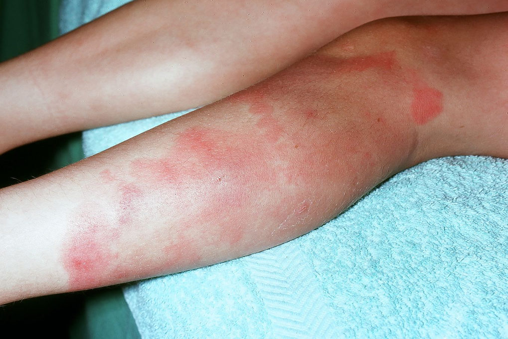 Erythema Nodosum Nhs