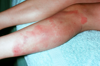 A person's lower left leg with large areas of red skin that look sore and painful. Image shown is on white skin.