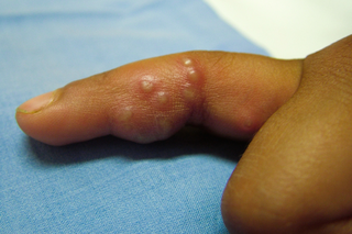 A swollen finger with red lumps under the skin and small blisters. Shown on brown skin.