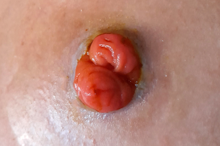 Loop ileostomy stoma on white skin. The stoma is dark pink and has two openings close together.