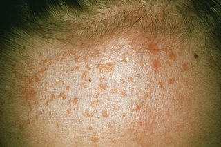 Lots of brown, flat warts on a person's forehead. Shown on white skin.