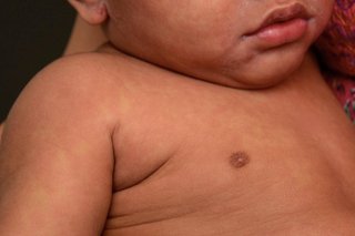 The measles rash on a child with brown skin. The rash looks like pale red to brown blotchy patches covering the child's arm, chest and face.