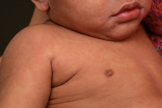 The measles rash on a child with brown skin. The rash looks like pale red to brown blotchy patches covering the child's arm, chest and face.