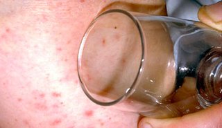 A clear glass being pressed against a red, spotty rash on white skin. The rash is not fading and is visible through the glass.