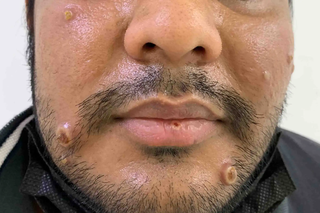 Sores (ulcers) and blisters on the face of an adult with Mpox, shown on light brown skin.