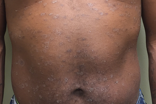 Widespread rash on the torso of a person with dark brown skin. There are many dark brown and grey spots close together.