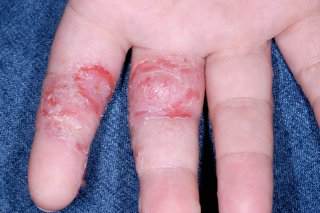 Pompholyx on the fingers of someone with white skin. Patches of skin are cracked, red and sore where the blisters  have burst.