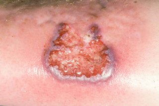 Pyoderma gangrenosum ulcer on white skin. The ulcer is dark pink underneath. It is light purple around the edge.