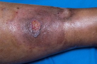 A pyoderma gangrenosum ulcer on the leg shown on dark brown skin. The ulcer looks red and around it is darker and slightly purple.