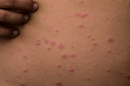 Stage 1 chickenpox, light brown skin. Spots are pink or skin colour. A more detailed image description is available next.