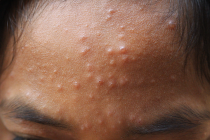 Stage 2 chickenpox on medium brown skin with pink or skin colour spots and blisters A long description is available next.