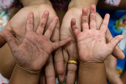 Medium brown skin with hand, foot and mouth disease spots on the palms. A long description is available next.