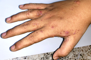 A rash with many small dark spots on a hand with brown skin.