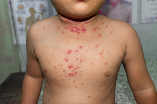 A child’s neck and torso showing many raised red spots, especially in the folds of the neck (shown on light brown skin).