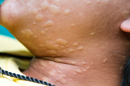 Light brown skin with bumps that look like blisters from hives. A more detailed image description is available next.