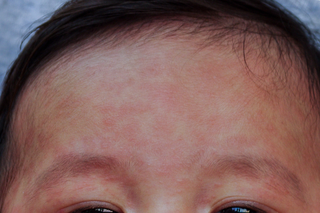 The measles rash on the forehead of a child with light brown skin. The rash looks like pale red blotchy patches.