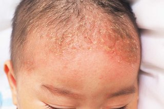 Yellow crusty patches on a baby's head. Some are larger than others. Shown on light brown skin.