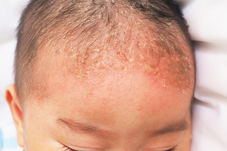 Yellow crusty patches on a baby's head. Some are larger than others. Shown on light brown skin.