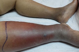 Skin on a person's lower leg is swollen, red, with area of dark brown. A line of black ink is above the swelling. Skin on the other leg is medium brown.