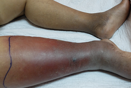 cellulitis-nhs