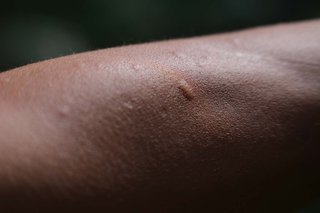 Mosquito bites shown on brown skin. There are several small raised bumps, which are the same colour as the skin.