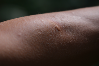 1 oval-shape bump from a mosquito bite. There are smaller bumps near it. Bumps are skin colour. Shown on dark brown skin.