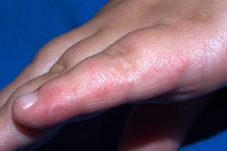 Small blister on young child's finger.