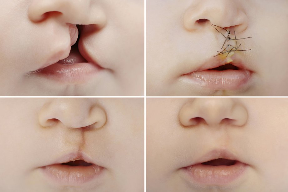 Pictures of cleft repair treatment