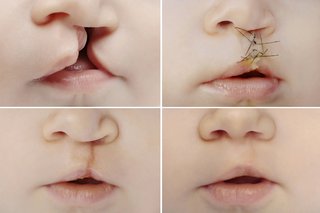 Gambar bibir sumbing sebelum dan sesudah operasi