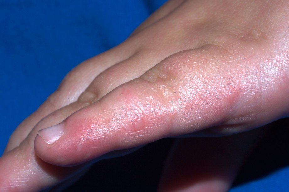 Tiny Blisters On Child S Fingers