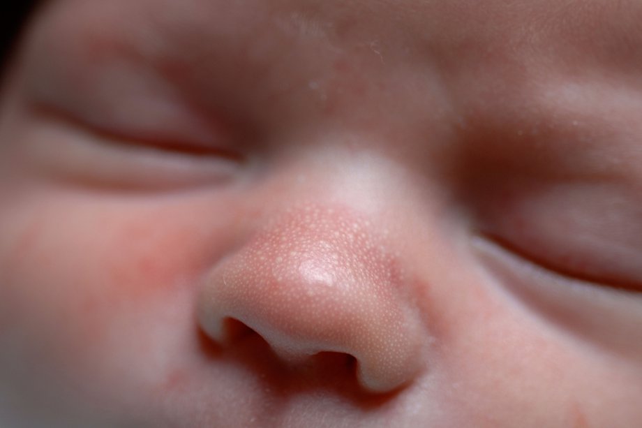 White spots on a baby's nose