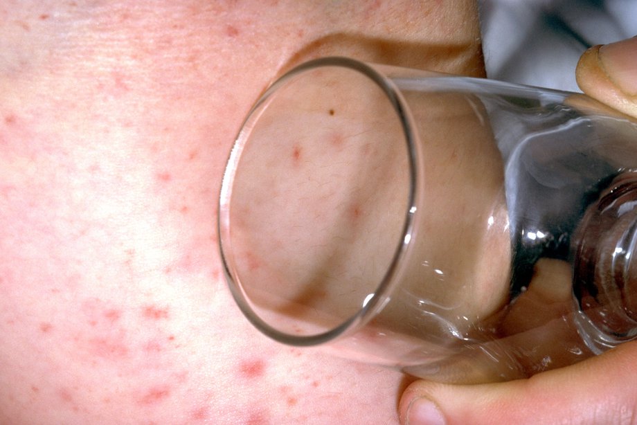 Red spotty rash on white skin with glasses pressed on it. The spots are still visible through the glass
