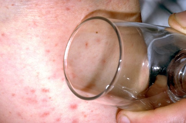 Picture of meningitis rash with glass