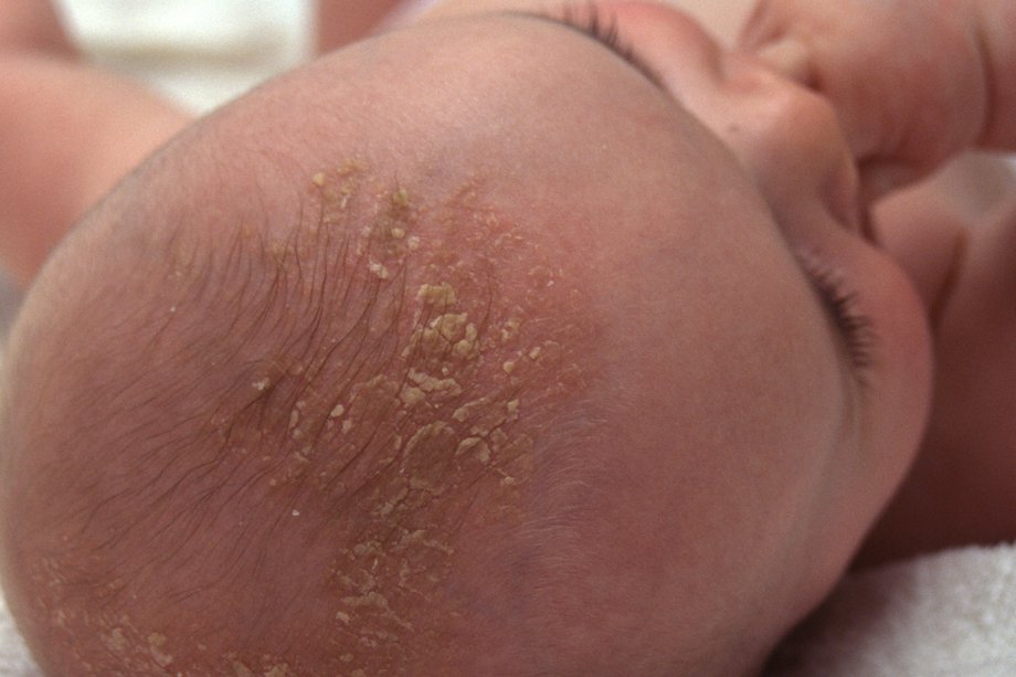 Cradle cap on a baby's head