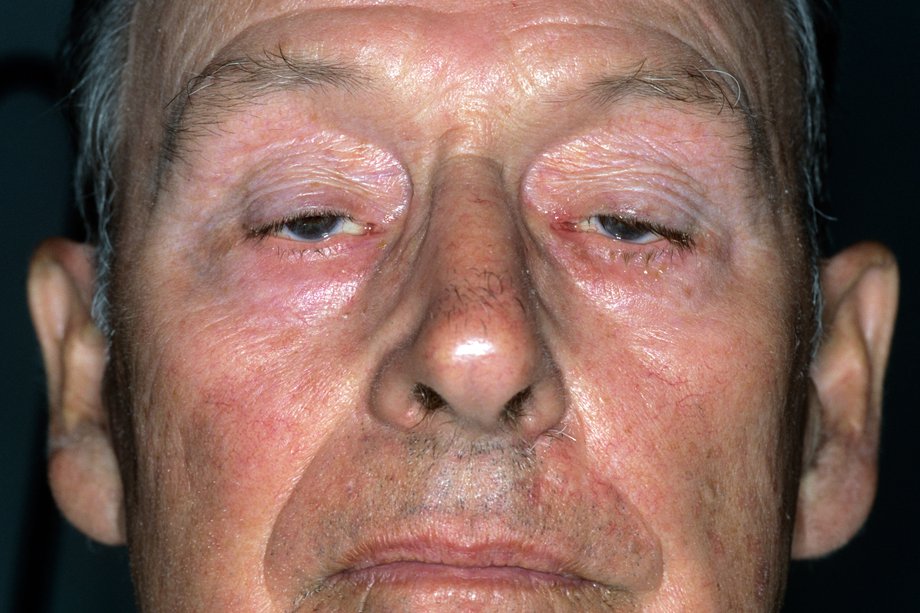 Picture of droopy eyelids caused by myasthenia gravis