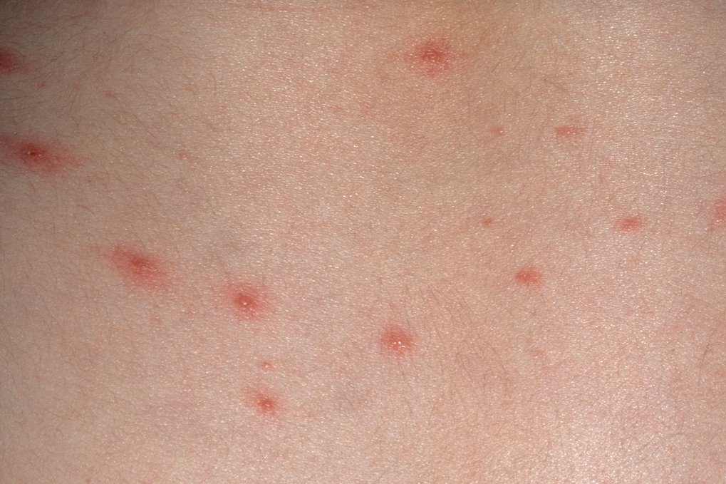Chickenpox The Tutbury Practice