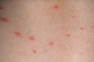 水痘：原因、症状および治療
