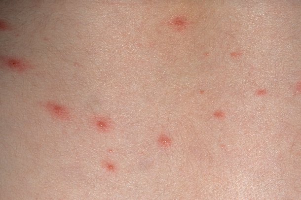 Chickenpox Nhsuk