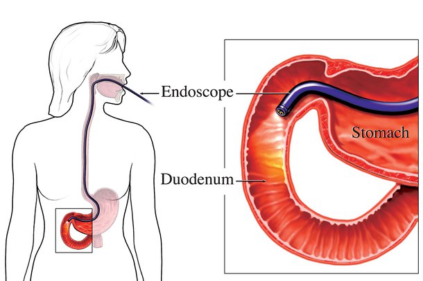 Diagram showing an endoscopy