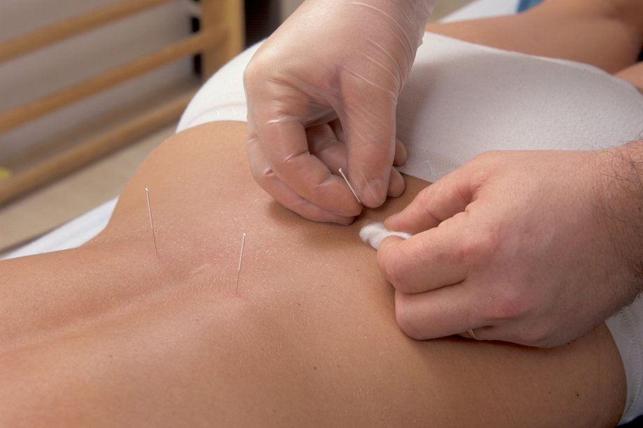 Picture of a person having acupuncture