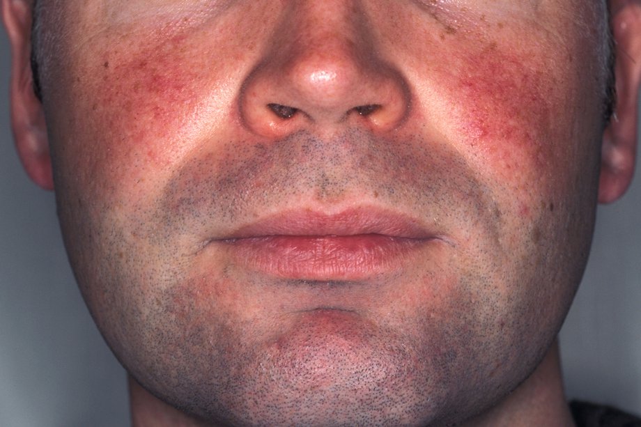 Picture of facial redness caused by rosacea