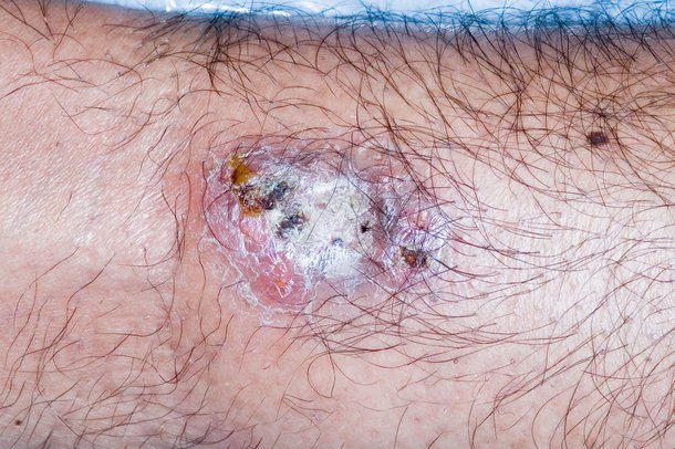 Pyoderma gangrenosum - NHS.UK