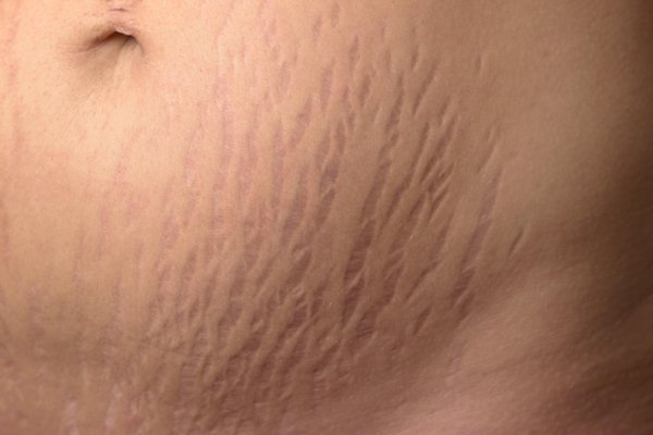 Stretch marks can be pink, red, brown, black, silver or purple. They usually start off darker and fade over time. Image Credit: Michael Heim / Alamy Stock Photo