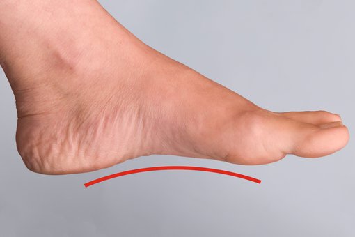 A woman's left foot with a raised area (arch) visible along the bottom of the foot