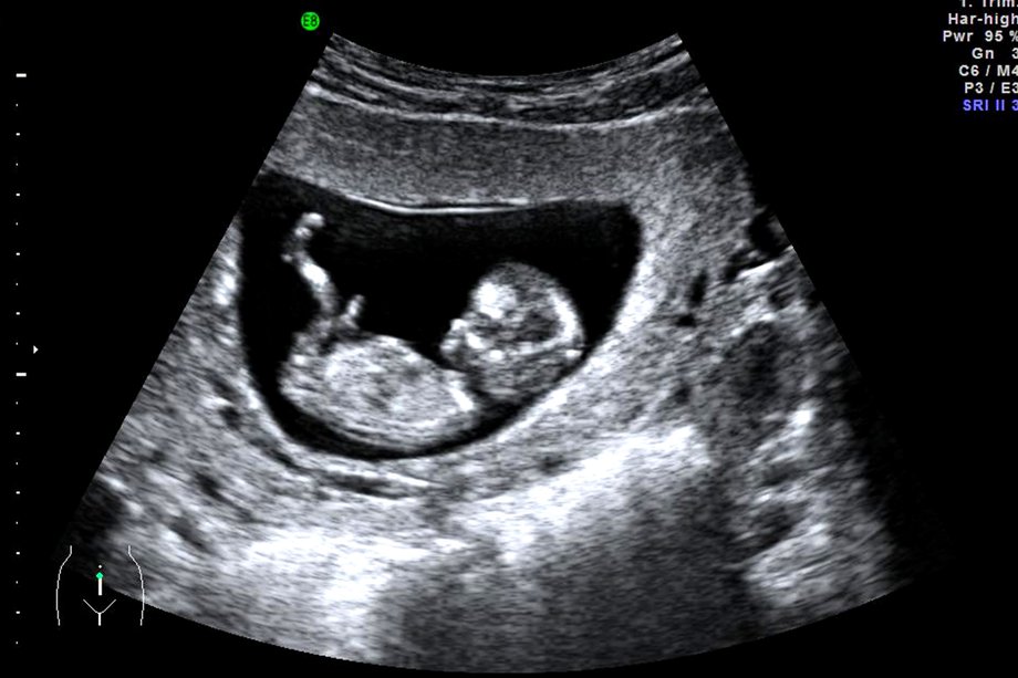 Ultrasound accuracy in pregnancy dating