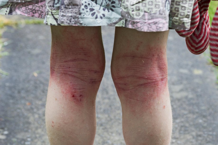 Skin rashes in children NHS.UK