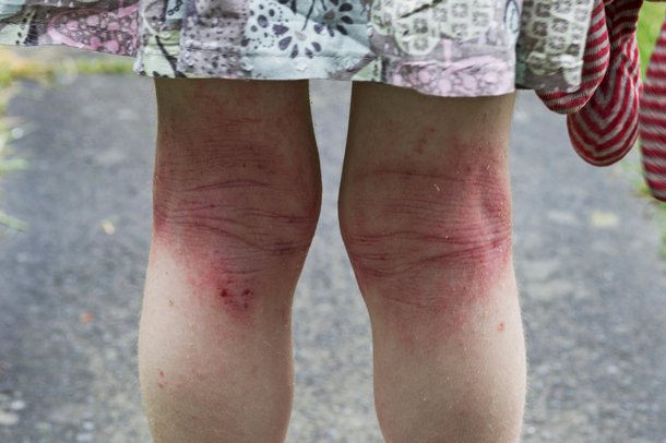 Skin rashes in children - NHS.UK